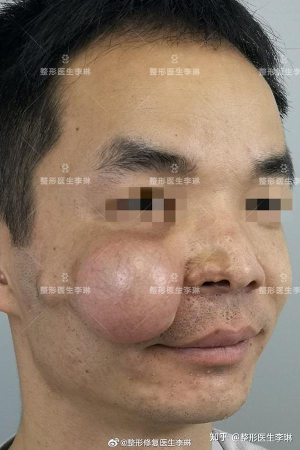 鼻翼再造术——男子幼年右鼻翼烧伤造成鼻翼缺损#李琳