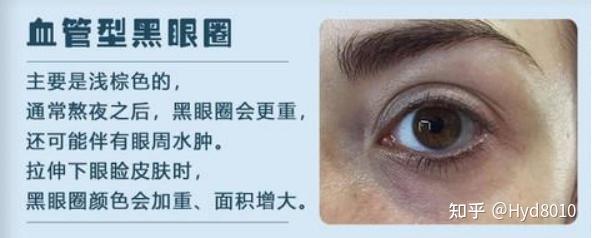 ①保持充足睡眠不要熬夜,说到底血管型黑眼圈就是因为眼部周围血液