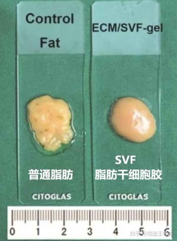 全网最全脂肪胶功课脂肪填充有必要使用脂肪胶吗脂肪胶是不是智商锐