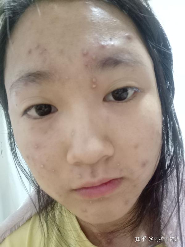 长水痘是一种怎么样的体验?
