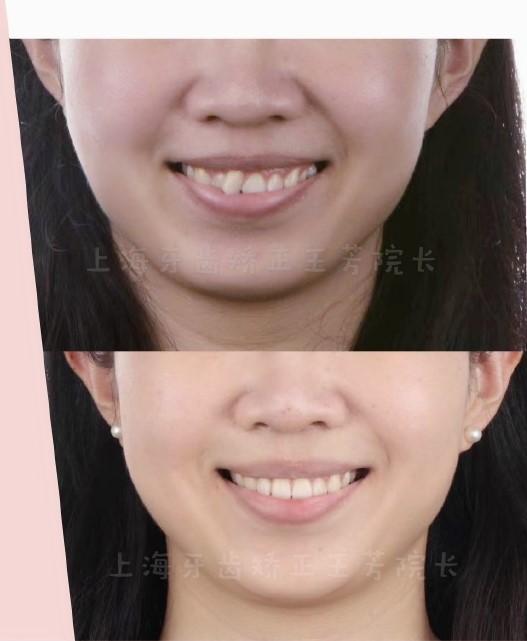 牙齿矫正收缝时会对脸型有哪些改变