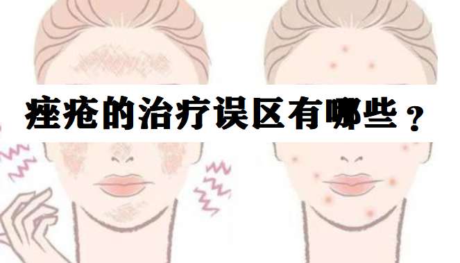 痤疮的治疗误区有哪些