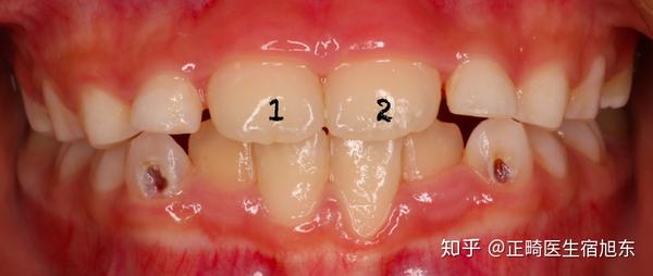 对称性换牙:上面或者下面的牙齿,都是对称性的换牙(可称为双胞胎