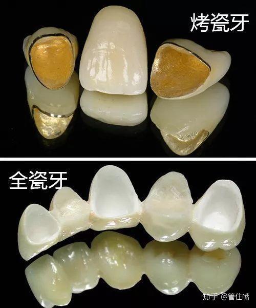 烤瓷冠修复基牙的必备条件及副作用