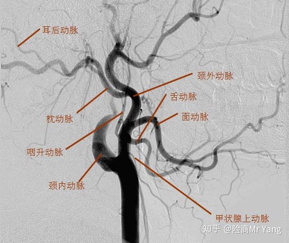 被所有人都忽略的高发轻症--颈动脉介入手术