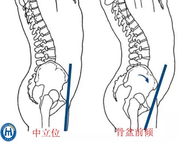 腰大肌起自腰椎椎体的侧面,腰大肌的被动短缩,骨盆前倾,造成腰椎稳定