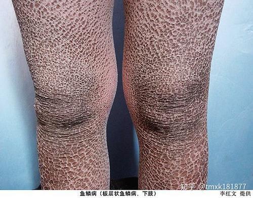 什么是先天性鱼鳞病