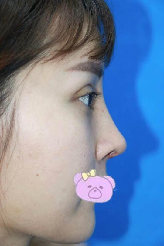 【真人案例】猪鼻子做鼻综合直接变成韩佳人同款小翘鼻