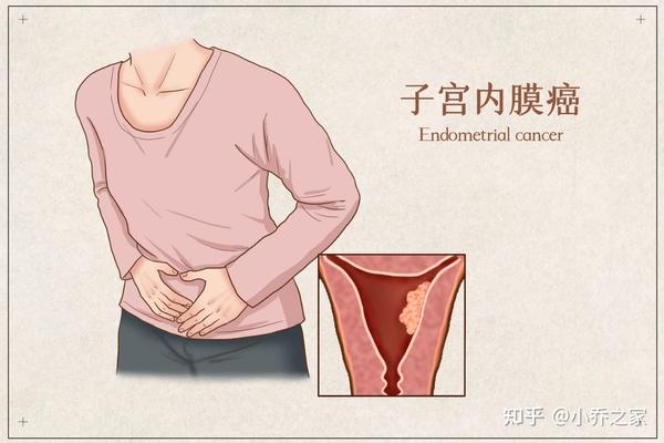 会使得子宫内膜腺体增生,宫腔面积会有所增大,其主要症状是阴道分泌物