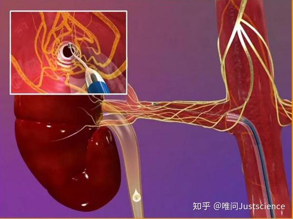 交感神经支配术恢复顽固性高血压导致的主动脉扩张