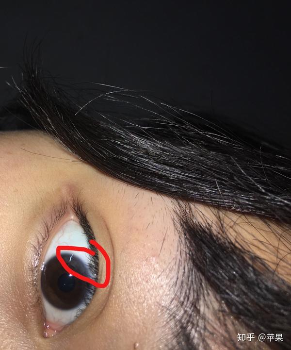 瞳孔周围有一圈白色的膜是怎么回事?