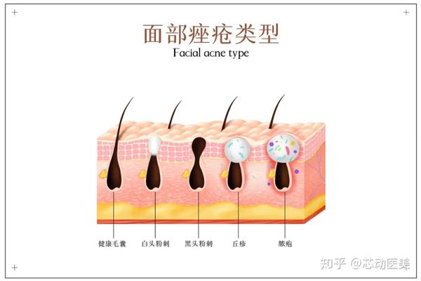 【祛痘篇】痘痘走了,留下的痘印该怎么办?