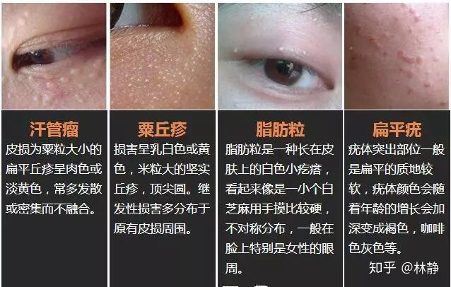 汗管瘤栗丘疹脂肪粒和扁平疣有什么区别看图一下就明白了