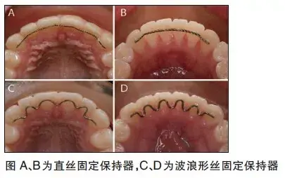 戴牙套的过程是怎样的?有什么危害?