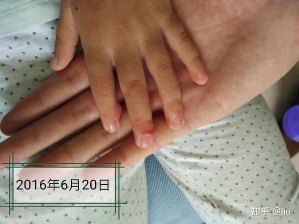 儿童手指纤包涵体维瘤
