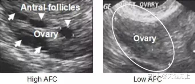 试管婴儿前为何要检查窦卵泡数目