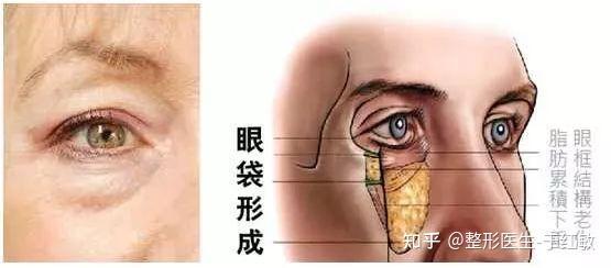 3分钟告诉你眼袋是怎么形成的