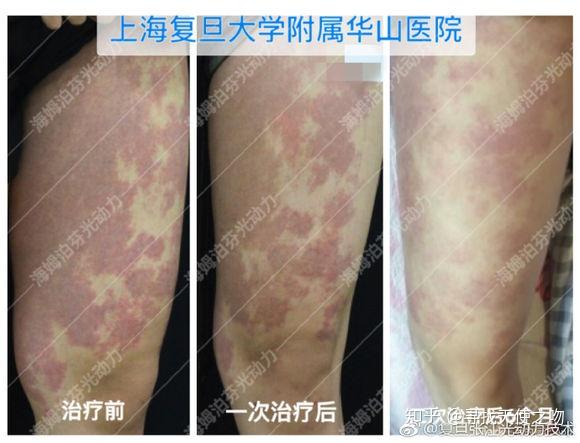 复美达光动力治疗红型,紫红型鲜红斑痣疗效图