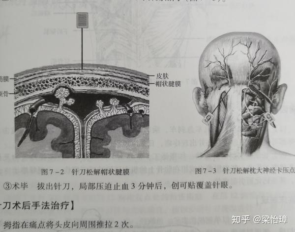 (参考《针刀治疗学》中国中医药出版社2012.08) 颞部