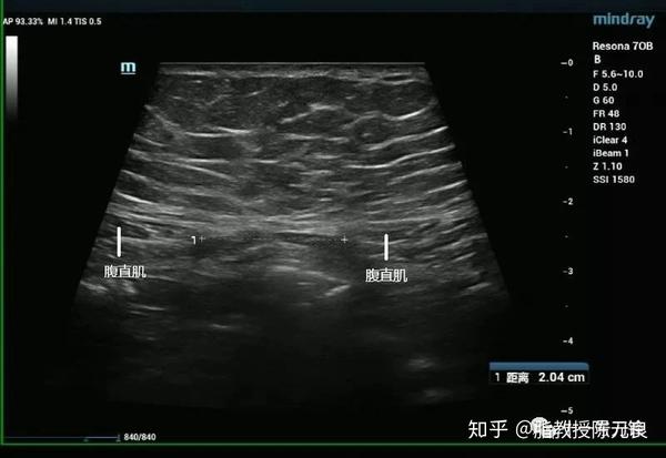 通过超声对腹直肌的观察及相关测量,我们可以获取腹直肌间距等相关