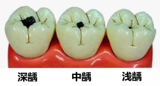 4岁男孩满口黑牙全烂光这些宝宝牙齿问题现在知道还来得及