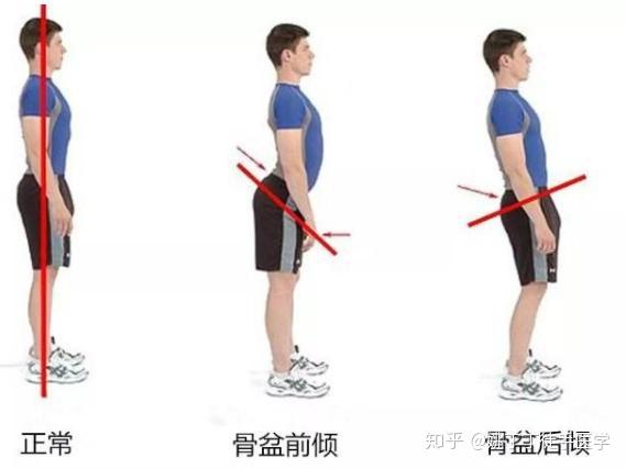 为什么做完收胯就翘臀,有可能是骨盆前倾了