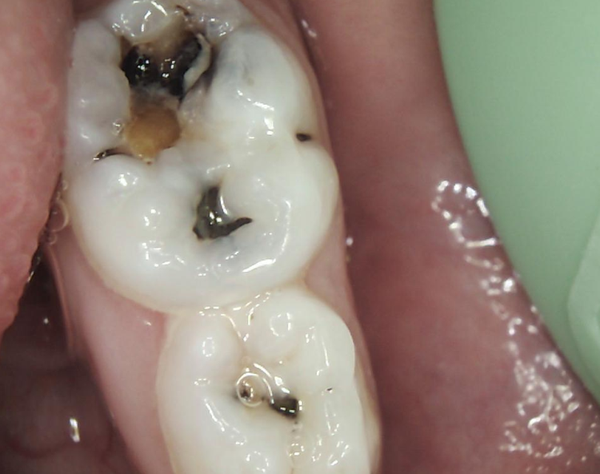 造成恒牙间隙缩小,因间隙不足发生位置异常;   5,乳牙龋坏破损的牙冠