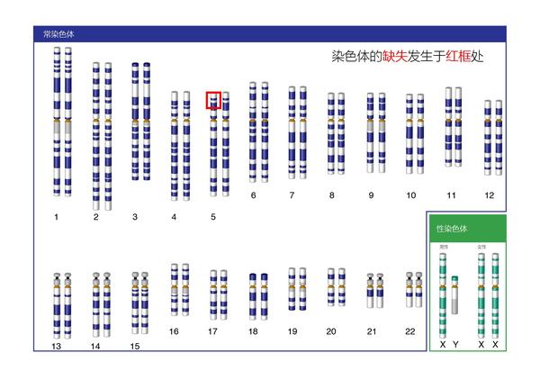 染色体综合征汇总要略:cri du chat syndrome(猫叫综合征)