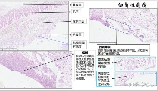 被破坏的粘膜层部位大量渗出的纤维素和炎性细胞以及坏死脱落的组织