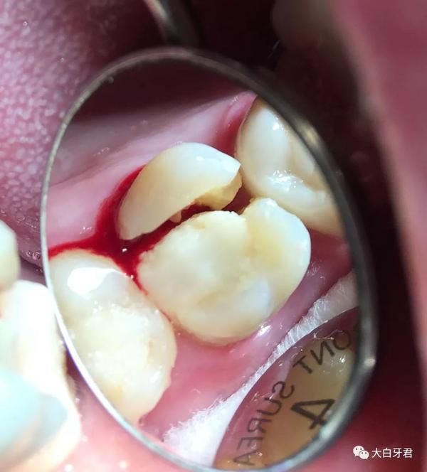 牙齿隐裂成长到最后,牙齿可能折当作两半.