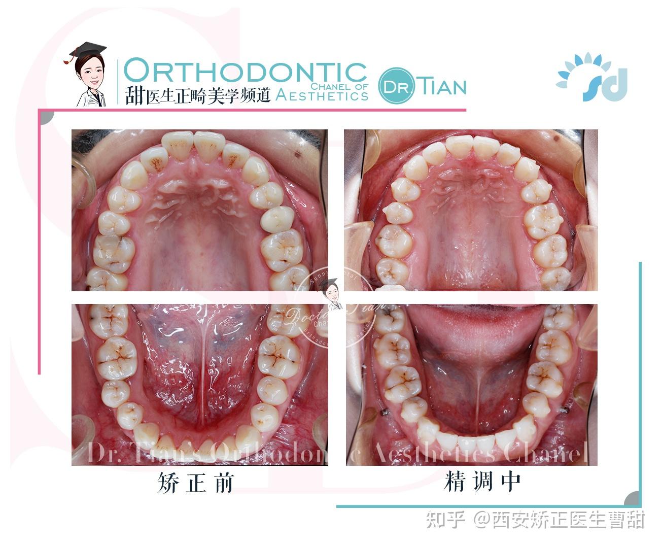 西安牙齿矫正曹甜案例嘴凸牙齿拥挤6号牙龋坏智齿牵引代替磨牙改善