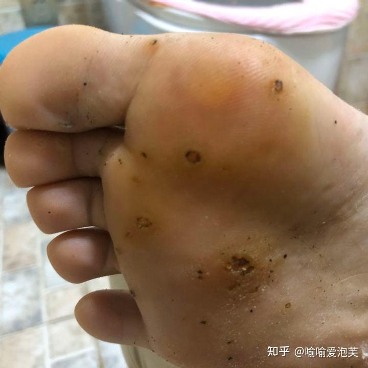 脚上长了跖疣如果去接种hpv疫苗会好吗