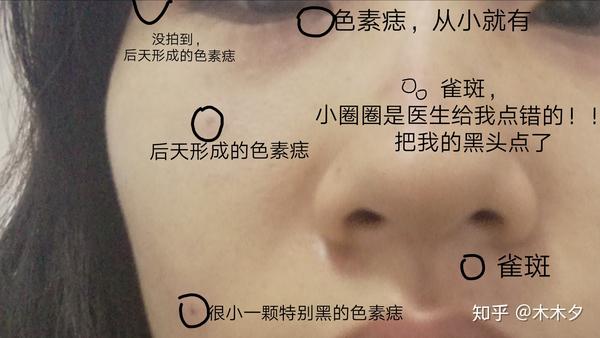 临近新年,我去冷冻祛痣了.