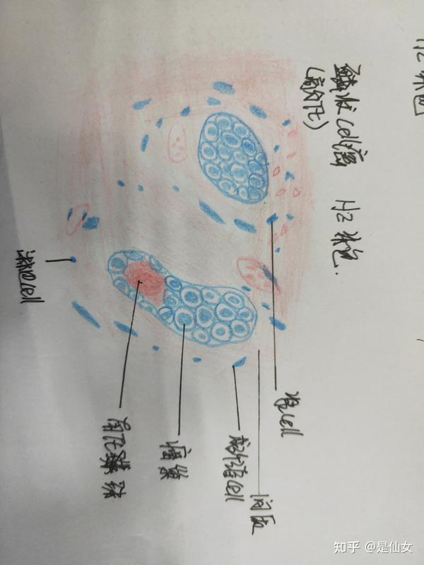 病理学红蓝铅笔绘画图 实验课题: 平滑肌瘤与鳞状上皮细胞癌
