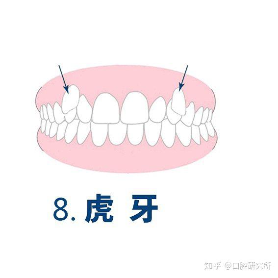 科普tips常见的几种牙齿畸形你是哪一种