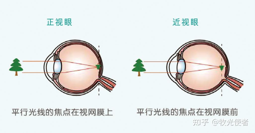 并没有正好落在视网膜上,为了看清楚成像眼睛会调动周围的肌肉拉长眼