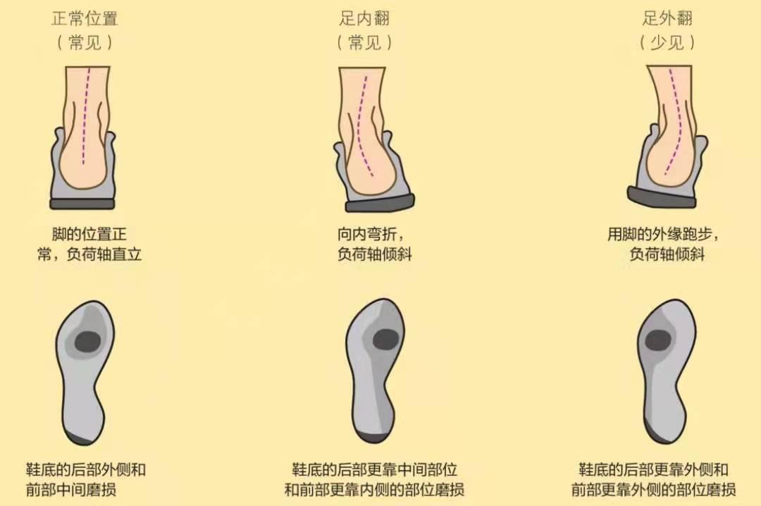 怎么分辨脚内翻还是外翻