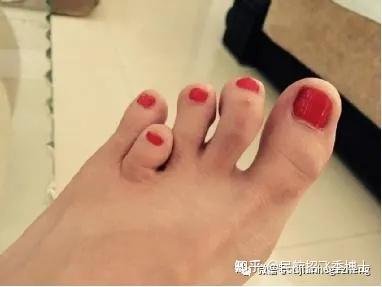 d型:主要拇指(趾)有短而宽的末端指骨.