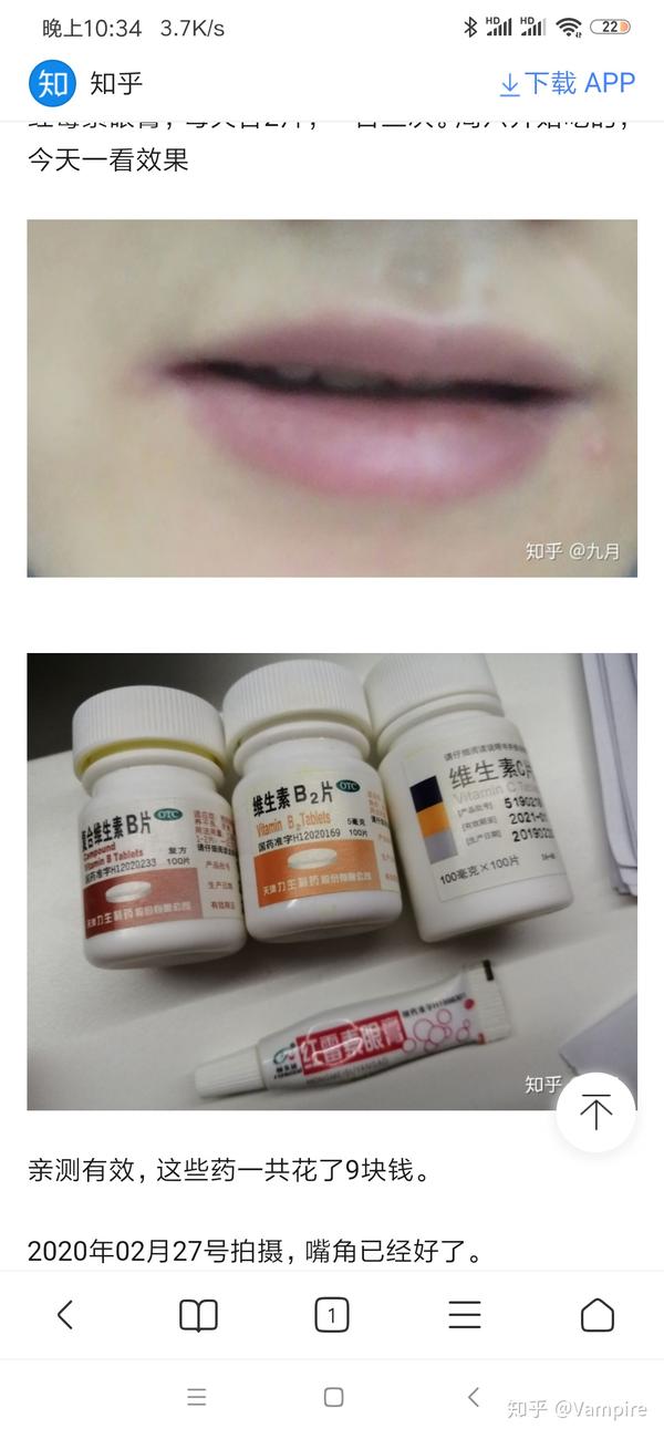 如何治疗口角炎