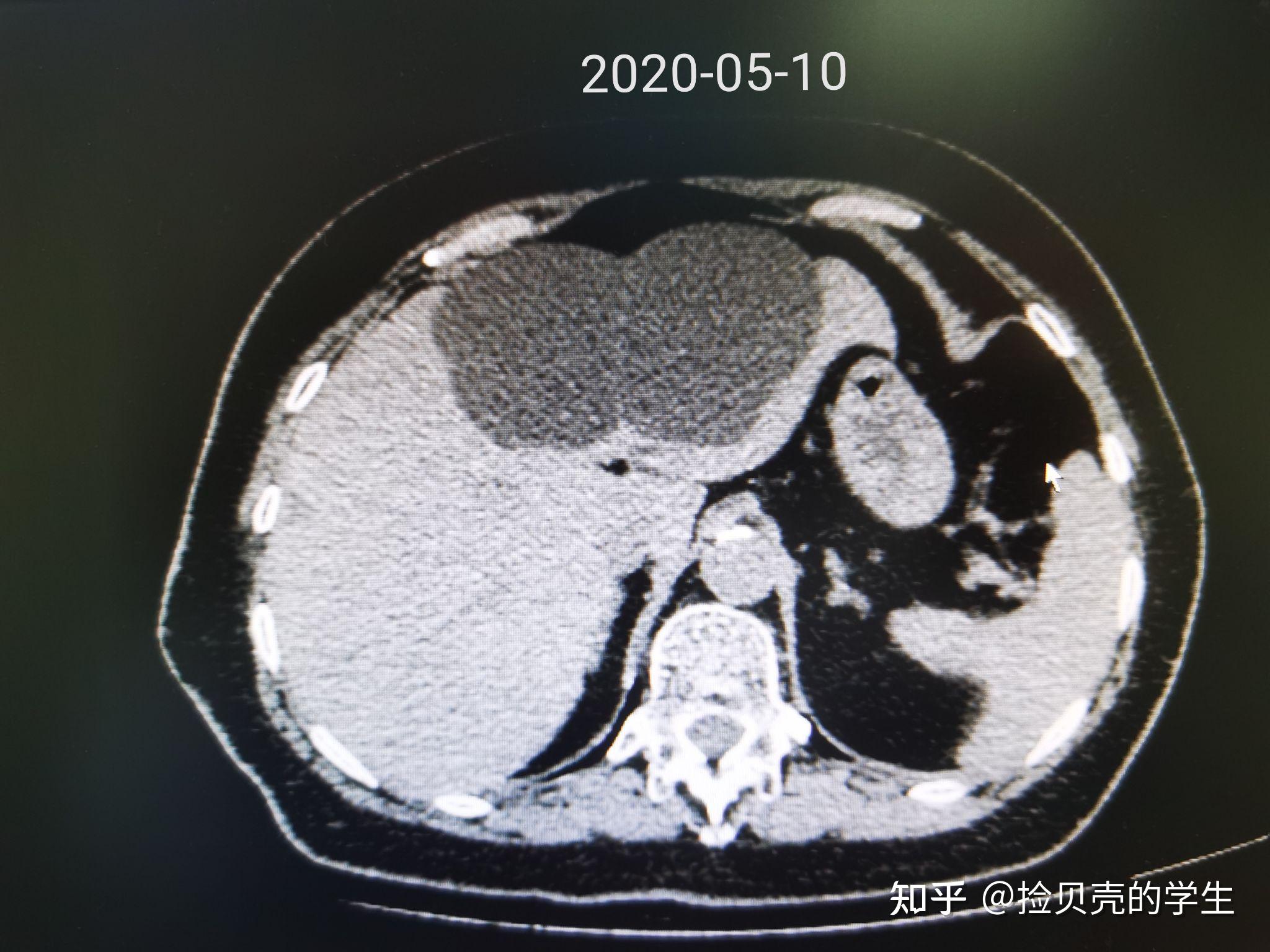 微创治疗肝囊肿