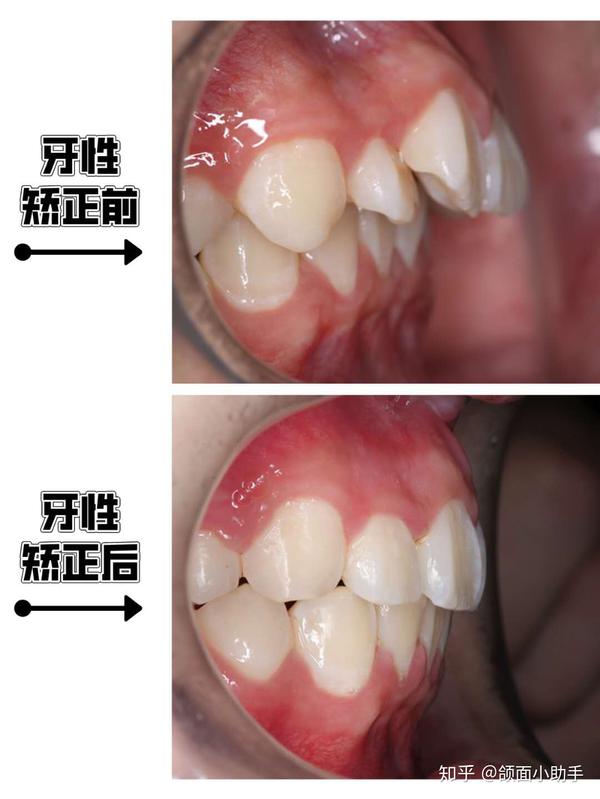 在家简单自测自己是骨性还是牙性凸嘴