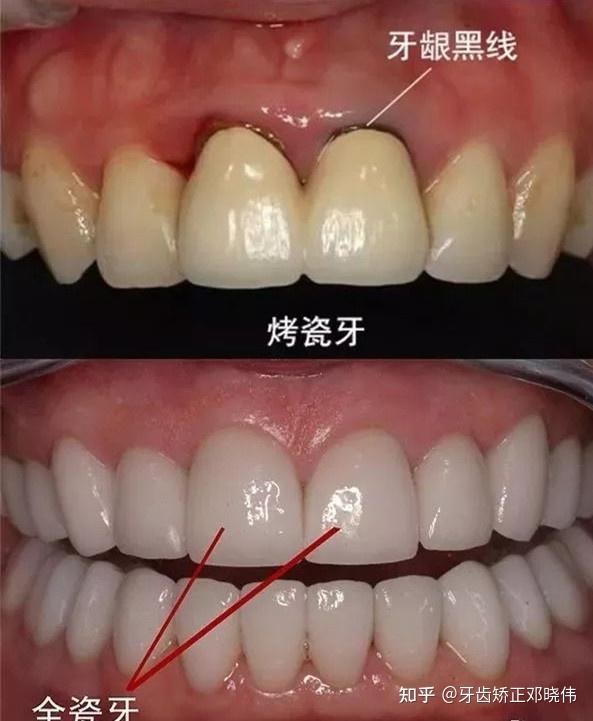 ③结构稳定,不崩瓷:全瓷牙是用瓷做的内冠,然后在内冠的外面包上一层