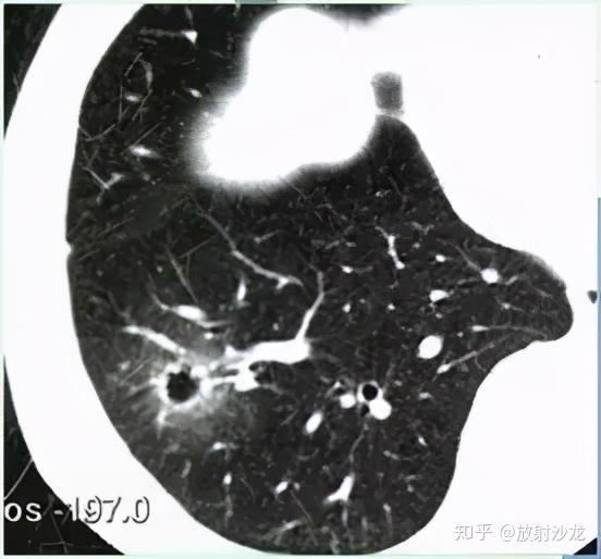 厚壁空洞(>3mm) "空气新月征"也可见于肺结核病例,常伴有钙化,多不随