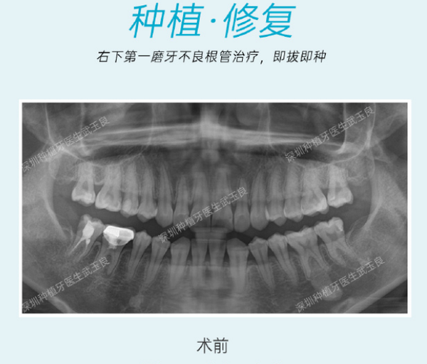 深圳种植牙-根管治疗后患者还是选择种植牙