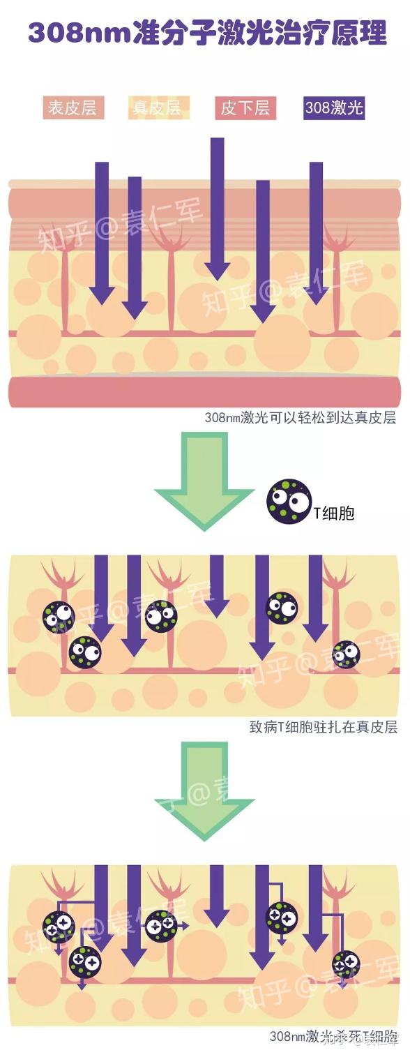 308准分子激光到底是怎么治疗白癜风的真的有作用吗