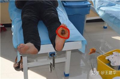 糖尿病患者足底出现黑点是什么原因?