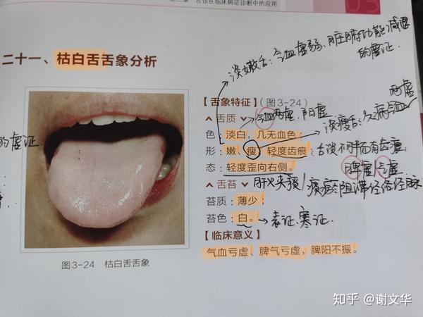 枯白舌舌象分析