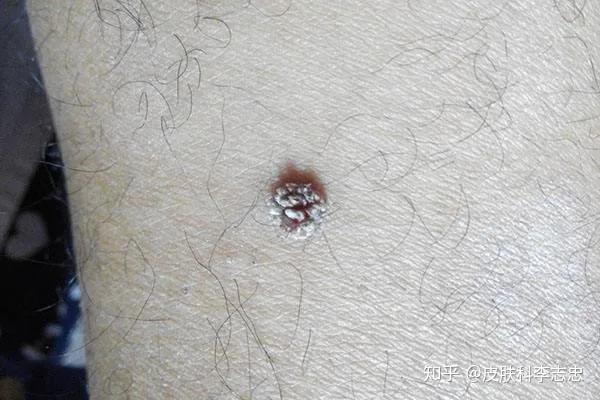 皮肤上长"瘊子"怎么治?一把芝麻花加荆芥叶就能解决!