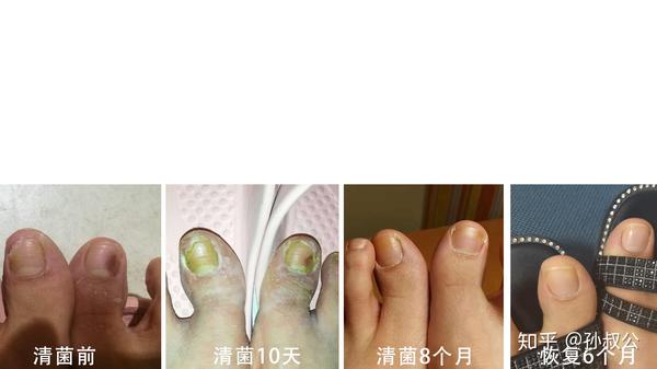 甲菌(灰指甲)实例 -- 恢复长征路