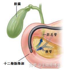 胆总管结石怎么办ercp不开刀口中取石